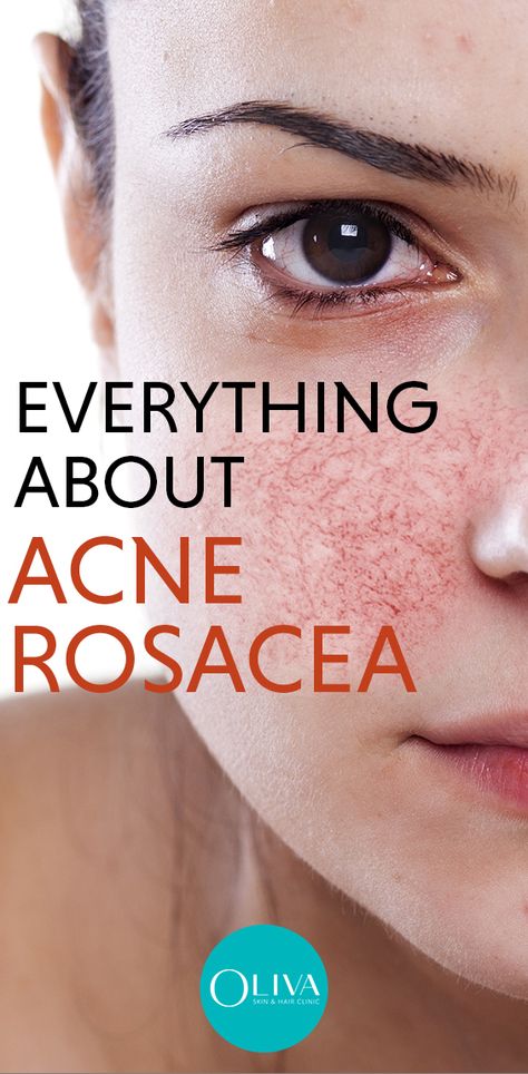 Rosy pink cheeks are beautiful to behold. But, don’t confuse it with rosacea. Rosacea is when the skin suffers from chronic inflammation that includes redness, spots, facial flushing, and thick and dry skin. Rosacea can also consist of bumpy and pus-filled pimples known as Acne Rosacea. Read on to understand more about this skin problem. #acnerosacea #pimplecare #acnetreatment #skincare #clearskin #acneremoval How To Get Rid Of Rosy Cheeks, Red Cheeks Remedy, Cheek Acne, Pimple Causes, Pimple Free Skin, Pimples On Forehead, Skin And Hair Clinic, Pimples Remedies, How To Get Rid Of Pimples