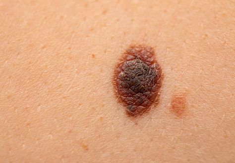 Learn how to spot the warning signs of a potentially cancerous mole. Cancerous Moles, Red Moles, Skin Moles, Blemish Remover, Cleveland Clinic, Medical Practice, Warning Signs, Health And Wellbeing, Mole