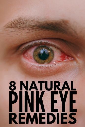 Home Remedies for Pink Eye: 8 Natural Remedies for Pink Eye that Work! Pink Eye Remedies, Remedies For Pink Eye, Treating Pink Eye, Pink Eye Home Remedies, Natural Pink Eye Remedy, Health Benefits Of Grapefruit, Narrow Laundry, Pinkeye Remedies, Home Remedies For Bronchitis