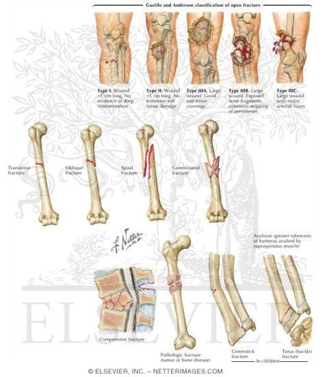 Gustilo and Anderson Classification of Open Fracture Open Fracture, Ankle Fracture, Medicine Student, Medical Terms, Emergency Medicine, Med School, Human Anatomy, Medicine