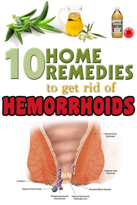 Hemorrhoid Remedies, Natural Home Remedies, Blood Vessels, Health Remedies, Natural Health, Home Remedies, Natural Remedies, Healthy Life, Health Tips