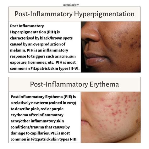 roadtoglow’s Instagram post: “🔍 POST INFLAMMATORY HYPERPIGMENTATION vs POST INFLAMMATORY ERYTHEMA. . 🔍 Post Inflammatory Hyperpigmentation (PIH): PIH is characterised by…” Post Inflammatory Erythema, Hyperpigmentation Remedies, Skin Anatomy, Post Inflammatory Hyperpigmentation, Acne Overnight, Treating Hyperpigmentation, Brown Spots On Face, Spots On Face, Azelaic Acid