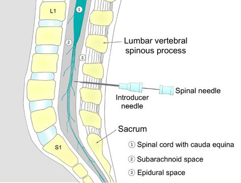 Spinal Anesthesia in Adults: Anatomy, Indications, and Physiological Effects - OpenAnesthesia Spinal Anesthesia, African Head Dress, Head Dress, Anatomy