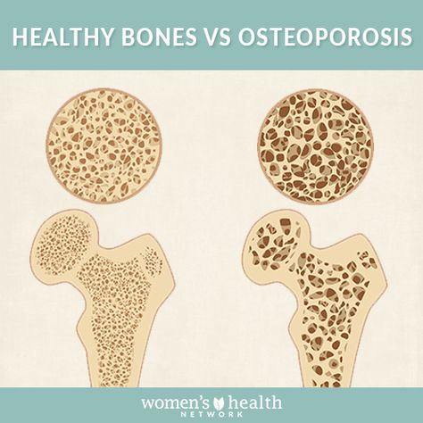 Bone Healing Foods, Osteoporosis Symptoms, Bone Healing, Hip Fracture, Said Quotes, Bone Diseases, Bone Loss, Healing Foods, Strong And Healthy