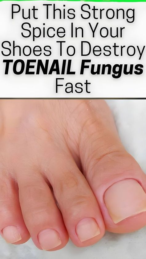 How To Clear Nail Fungus 3X Faster Even While Sleeping. ( Just Add 2 Drops of This ! Simple and Effective Natural remedies for Toenail Fungus. Fungal Infection Remedies, Nail Disorders, Toenail Fungal Infection, Nail Remedies, Toenail Fungus Remedies, Nail Fungus Remedy, Fungal Nail, Clear Nail, Nail Care Routine