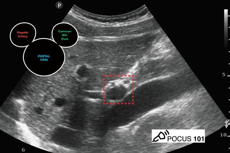 Ultrasound Abdomen Boards, Liver Ultrasound Images, Sonography Notes, Abdomen Ultrasound, Diagnostic Medical Sonography Student, Abdominal Ultrasound, Ultrasound School, Liver Anatomy, Sonography Student