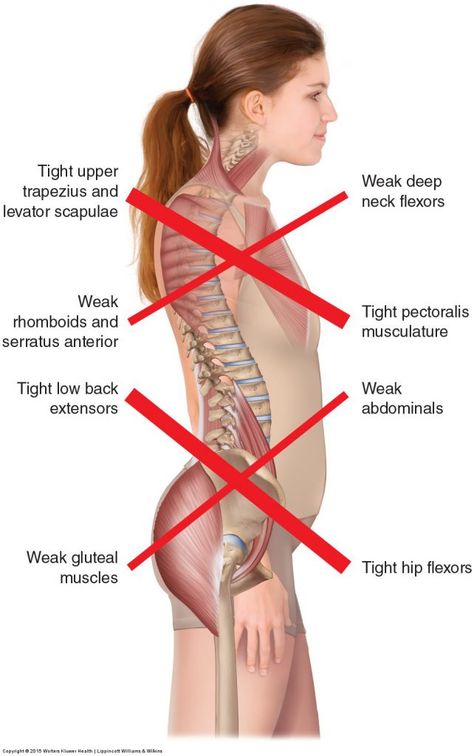 Upper Crossed Syndrome Exercises, Upper Cross Syndrome, Lumbar Lordosis, Thoracic Spine, Pilates Teacher, Tight Hip Flexors, Pelvic Tilt, Fit Club, Upper Back Pain