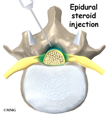 Spinal Canal Stenosis, Spinal Degeneration, Pelvic Bone, Spinal Surgery, Nerve Fiber, Spinal Nerve, Spine Health, Spine Surgery, Sciatica Pain