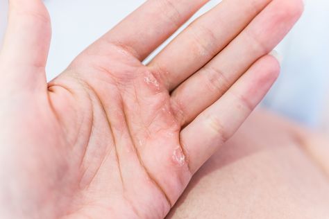 We’ve written recently about how much your fingernails can tell you about your health. But it turns out you can tell a lot from looking at the rest of your hands, too. The NHS says problems with the wrist, hand and fingers are common and can be caused by simple things like carrying out repetitive tasks or an injury during sports or a fall. So, there might not be any need to panic if your hands have become a little sore.But while some problems have obvious causes and are minor, others can be s... Uk Life, Free Homeschool Printables, Health Signs, Thyroid Issues, Skin Spots, Flag Signs, Autoimmune Disorder, Shortness Of Breath, Red Flag