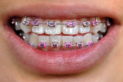 Black Braces Teeth, Hot Pink Braces, Power Chain Braces, Braces Transformation, Dental Braces Colors, Pink Braces, After Braces, Black Braces, Teeth Aesthetic