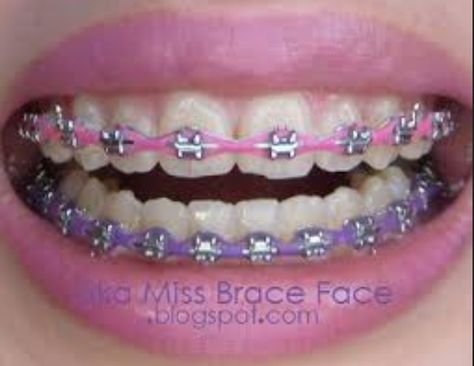 Cute multicolored braces Lilac Braces, Braces Colours, Braces Transformation, Dental Braces Colors, Braces Colors Combinations, Invisible Teeth Braces, Braces Ideas, Pink Braces, Braces Retainer