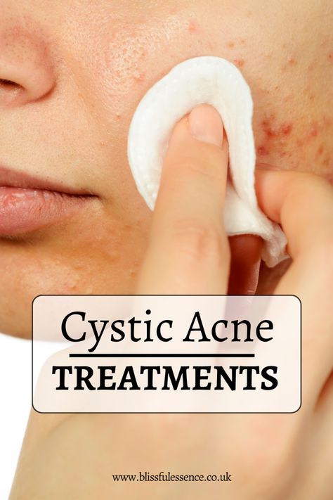 Want to know the obvious secrets to treating cystic acne? Look no further! Our comprehensive guide reveals proven strategies and expert tips for achieving clearer skin. Don't let acne hold you back any longer! #CysticAcneTreatment #CysticAcneRemedies #CysticAcneTreatmentOvernight #GetRidOfCysticAcne #TreatCysticAcne #CysticAcneSkincareRoutine Cystic Acne Skincare Routine, Why You Get Acne In Certain Areas, Treat Hormonal Acne, Active Acne Remedies, Treating Cystic Acne, Cystic Acne Remedies, Acne Skincare, Acne Skincare Routine, Skin Care Routine 30s