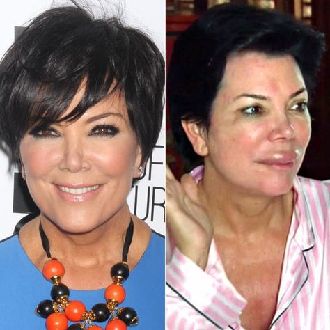 Image result for kris jenner Kris Jenner Plastic Surgery, Lip Plastic Surgery, Chris Jenner, Kris Jenner Hair, Kim Kardashian Before, Kris Jenner Style, Swollen Lips, Botox Brow Lift, Jenner Hair