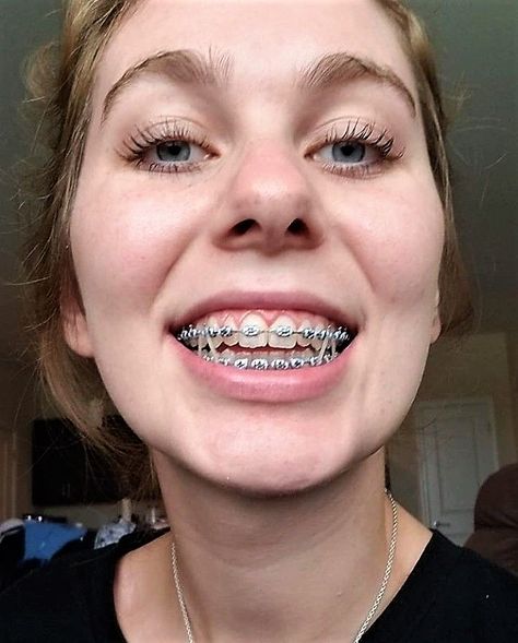 Braces Girl, Invisible Teeth Braces, White Braces, Braces And Glasses, Zoom Teeth Whitening, Natural Teeth Whitening Diy, Cute Braces Colors, Braces Elastics