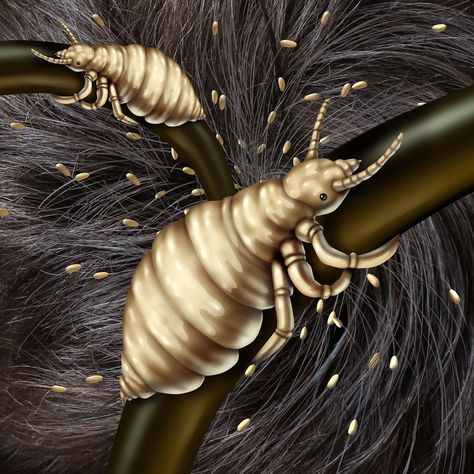 ALL ABOUT THE LICE THAT LIVE IN HAIR Lice In Hair, Hair Lice, Lice Eggs, Hair Poster, Head Louse, Small Insects, Human Head, Hair Problems, About Hair