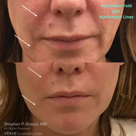 Nasiolabel Folds Filler, Smile Lines Filler Before And After, Marionette Lines Before And After, Smile Line Filler, Marionette Lines Filler, Nasolabial Fold Filler, Botox Filler, Marionette Lines, Cheek Fillers