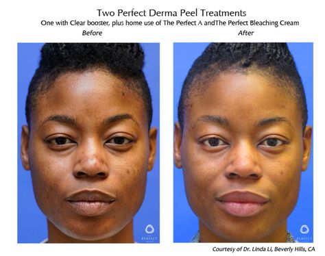 BEST CHEMICAL PEEL FOR DARK SPOTS Perfect Derma Peel, Best Chemical Peel, Chemical Peels, Acne Control, Acne Breakout, Layers Of Skin, Improve Skin Texture, Chemical Peel, Skin Texture