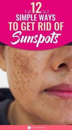 Sun Spots On Skin, Sunspots On Face, Spot Remover For Face, Age Spots On Face, Brown Spots On Skin, Dark Spots On Face, Brown Spots Removal, Brown Spots On Face, Sun Damaged Skin