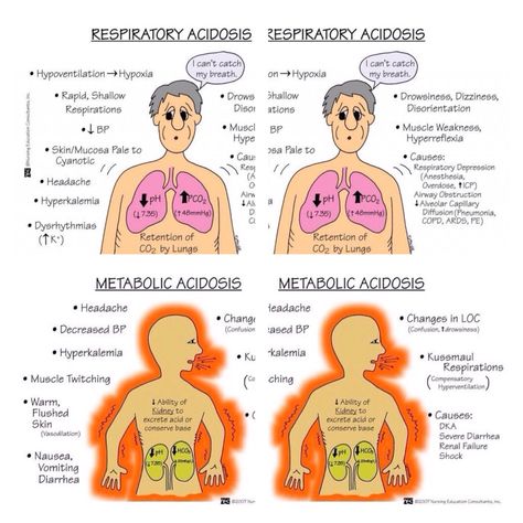 Metabolic Acidosis/Respiratory Acidosis Metabolic Acidosis Vs Alkalosis, Metabolic Renewal, Metabolic Confusion, Acidosis And Alkalosis, Respiratory Acidosis, Metabolic Acidosis, Med Surg Nursing, Nursing Mnemonics, Surgical Nursing