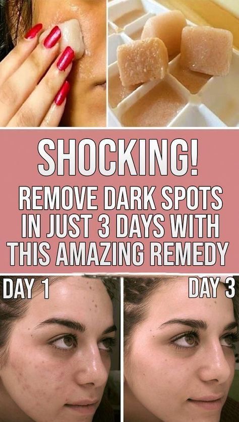 Black Spots On Face, Brown Spots On Hands, Brown Age Spots, Juice Ice Cubes, Potato Juice, Brown Spots On Skin, Spots On Legs, Brown Spots Removal, Brown Spots On Face