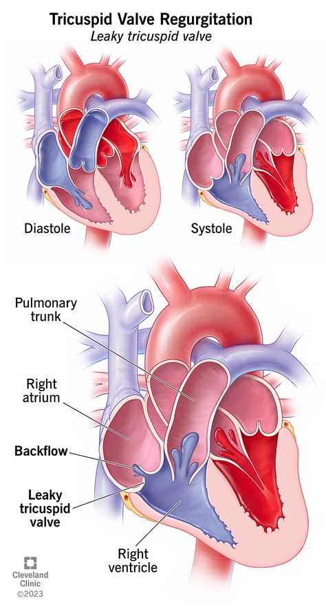 Heart Valve, Tricuspid Valve, Heart Valves, Cleaning Your Ears, Atrial Fibrillation, Heart Rhythms, Thread Up, Bacterial Infection, Blood Test