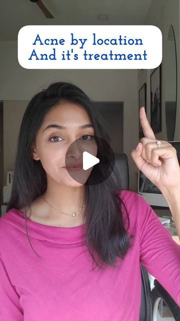 Dr.Nidhi Sawant on Instagram: "Acne can appear in various locations on the body, not just the face. The location of acne can provide insights into potential causes or contributing factors. . Forehead: Causes: Haircare products. Oily scalp. Digestive issues. Types: Whiteheads, blackheads. Use soap which contains ketoconazole and anti-dandruff shampoo. Cheeks: Causes: Dirty pillowcases or phones. Poorly cleaned makeup brushes. Hormonal fluctuations. Types: Whiteheads, blackheads, papules, pustules. Use a clindamycin+ nicotinamide gel or Salicylic acid facewash. Chin and Jawline: Causes: Hormonal fluctuations (common in women). Polycystic Ovary Syndrome (PCOS) in some cases. Types: Hormonal acne, cystic acne. Use benzoyl peroxide cream or Adapalene gel. Back (Back Acne or Bacne): Ca Acne Location Meaning, Clindamycin For Acne, Chin Whiteheads, Cheek Acne Cause, Forehead Acne Cause, Cheek Pimples, Acne On Cheeks, Pustules Acne, Chin Acne Causes