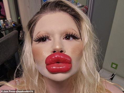 Lips With Filler, Lip Implants, Strange People, Botox Lips, Fake Lips, Lip Augmentation, Facial Wrinkles, Lip Injections, Cosmetic Procedures