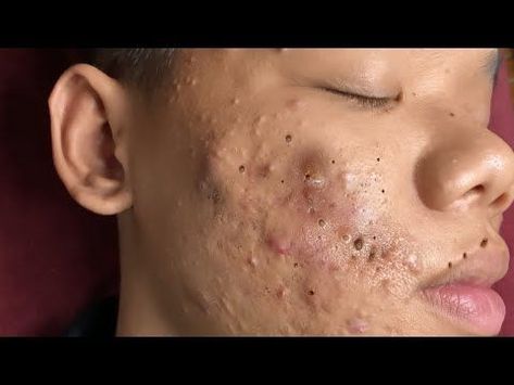 Lip Pimple, Cystic Pimple, Face Mapping Acne, Blind Pimple, Pimples Under The Skin, Zit Popping Videos, Zits Popping, Pimples On Face, Good Skin Tips