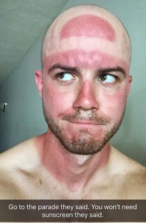 Who Needs A Farmer's Tan When You Can Get A Cavs Finals Hat Burn Sunburn Funny, Funny Sunburn, Sunburn Face, Sunny Day Images, Severe Sunburn, Farmers Tan, Funny Lists, Funny Sun, Bad Sunburn