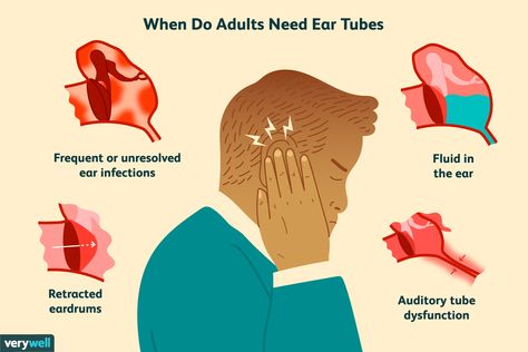 Ear Tubes for Adults: Preparation, Procedure, Recovery Drain Ear Fluid, Infected Ear Piercing, Ear Drainage, Eustachian Tube Dysfunction, Fluid In Ears, Ear Tubes, Ear Anatomy, Throat Infection, Middle Ear