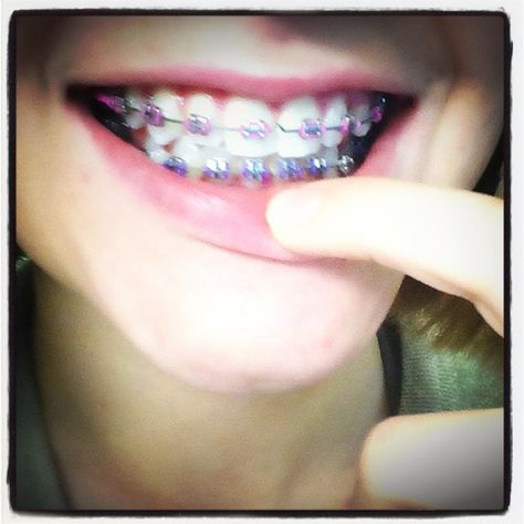 Pink and purple braces Braces Pink, Purple Braces, Braces Ideas, Pink Braces, Adult Braces, Getting Braces, Orthodontic Appliances, Brace Face, Braces Colors