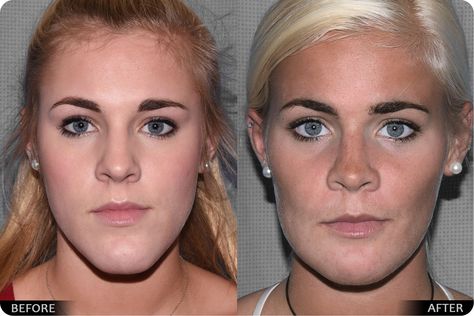 Post Jaw Surgery Liquid Diet, Jaw Reduction Surgery Before After, Jaw Surgery Before And After Underbite, Jaw Surgery Before And After Overbite, Double Jaw Surgery, Orthognathic Surgery, Jaw Reduction Surgery, Jaw Surgery, Facial Bones