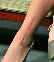 Seattle Plastic Surgeon discusses the importance of keeping fresh scars out of the sun. This ankle scar would have turned out much better had it been protected from the sun! Leg Scars, Broken Ankle, Leg Injury, Shoulder Surgery, Going To Rain, David Letterman, The Big Bang Theory, Kaley Cuoco, Plastic Surgeon