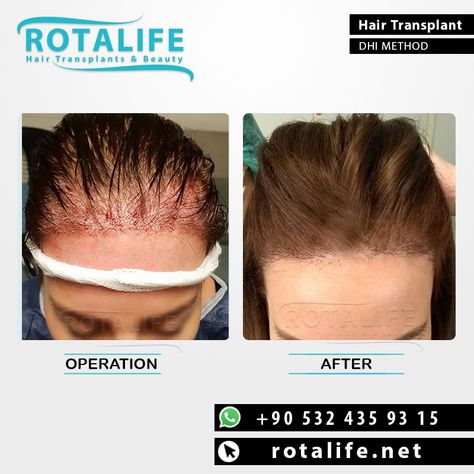 Eyebrow Implants, Eyebrow Hair Transplant, Female Hair Transplant, Turkey Women, Hair Transplant Video, Eyebrow Transplant, Hair Transplant Before And After Turkey, Hair Transplant Before And After Men, Hair Transplant Women