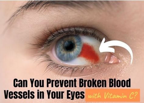 how to prevent broken blood vessels in eyes Blood Vessel In Eye, Blood Vessels, Vitamin C, Your Eyes, Vitamins, Health