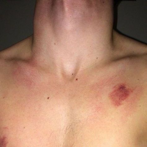 Hand Around Neck Aesthetic, Hicks On Neck Girl, Hickey On Boy, Love Bite Photos Aesthetic, Aesthetics Hickeys, Love Bite Photos Couples, Love Bites Hickey For Boys, Hickies Neck Boys, Aesthetic Couple Hickey