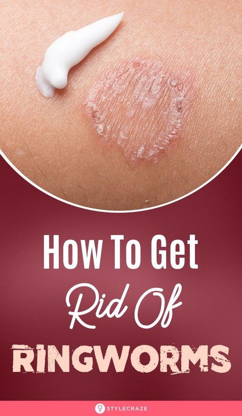 15 Powerful Home Remedies To Get Rid Of Ringworms: People who share locker rooms or swimming pools or have pets stand a greater risk of contracting the infection. But, don’t worry! Ringworm can… More Ring Worm Remedies, Ring Worm, Fungal Infection Skin, Natural Antibiotics, Sinus Infection, Fungal Infection, Daily Health Tips, Natural Home Remedies, Health Remedies