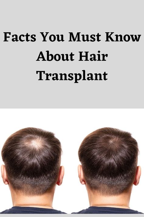 A hair transplant is a surgical process. There are several techniques that doctors can use to do a hair transplants and it’s best to choose the hair transplant methods carefully, as they all have their own pros and cons. This Links examines the facts about hair transplant surgery. Facts About Hair, Products For Thinning Hair, Hair Transplant Before And After, Hair Replacement For Men, Hair Transplant Video, Before And After Hair Transplant, Receding Hair Styles, Hairtransplant Men, Hair Implants