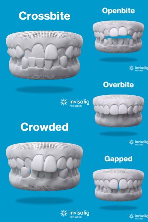 Orthodontics Teeth, Dental Assistant Study, Dental World, Teeth Alignment, Remedies For Tooth Ache, Dental Posters, Dental Hygiene School, Clear Braces, Dental Fun