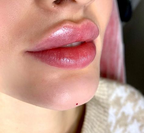 ✅ chin correction done ✅ new lips 👄🔥 How do you like this result? ___________________ Amaks Aesthetics Med Spa 📍1934A Williamsbridge Rd, Bronx, NY For appointments or free consultations, DM or call 🌸 📲 (917) 701-0253 📞 (585)441-3838 #lipfillernewyork #lipfillersnewyork #lipfillernyc #lipinjectionsnyc #lipinjectionsnewyork #lipfillerbronx #lipfillersbronx #lipsinjectionnyc Lip Fillers Inspiration, Pouty Lip Filler, Russian Lips Filler, Russian Lips, Lips Fillers, Chin Filler, Pmu Artist, Lips Inspiration, Facial Fillers