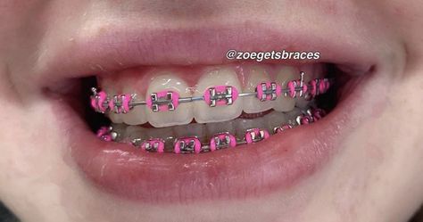 Braces Colors Hot Pink, Rose Pink Braces, Braces Pink, Braces Colors Pink, Dark Pink Braces, Light Pink Braces, Neon Pink Braces, Brackets Aesthetic, Hot Pink Braces