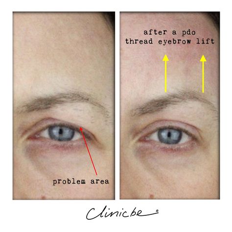 PDO threads can be used for the face and body to help strengthen areas of the face or to create a lift. In this instance an eyebrow lift helped to raise a hooded lid making the patient look less tired and the eye more open. Pro Thread Lift Before And After, Pdo Thread Lift Eyebrow, Hooded Eyes Surgery, Pdo Threads Under Eyes, Thread Face Lift Before And After, Botox Eye Lift, Hooded Eye Surgery Before And After, Botox For Hooded Eyes, Pdo Threads Before And After