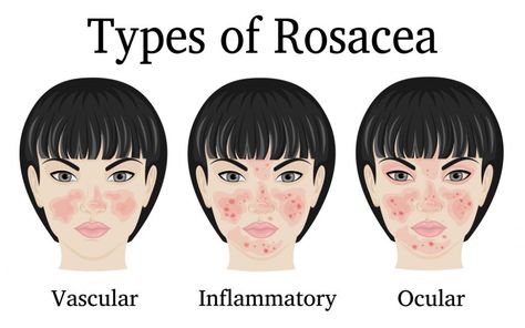 Rosacea is a chronic skin condition that presents as redness or flushing on the face, predominantly on the nose and cheeks. In more severe cases symptoms can range from rough or bumpy skin texture, swollen facial features, and even eye problems. About five percent of the population of the United States have rosacea. Redness On Face, Rosy Skin, Lemongrass Spa, Apple Stem, Facial Treatments, Minimize Wrinkles, Bumpy Skin, Aging Face, Anti Aging Face Cream