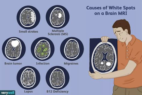 Spots on an MRI: White Matter Hyperintensities White Matter In Brain, Brain Mri, Mri Brain, Angina Pectoris, Peripheral Nerve, Multiple Sclerosis Awareness, Frontal Lobe, White Matter, Brain Scan