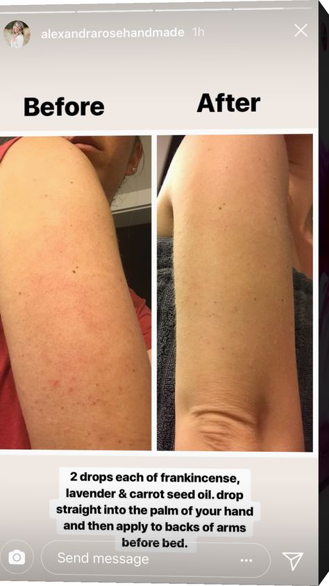 Get rid of bumps on arms Bumps On Arms, Obličejové Masky, Routine Skin, Natural Organic Skincare, Organic Skin, Healthy Skin Care, Beauty Skin Care Routine, Health And Beauty Tips, Anti Aging Skin Products