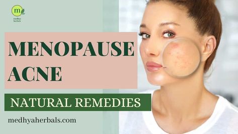 Learn about the causes, symptoms, and natural remedies for menopausal acne. Discover natural remedies and highly effective skin care tips. Hormonal Breakouts Remedies, Acne Natural Remedies, Hormonal Imbalances, Natural Acne Remedies, Night Time Skin Care Routine, Best Skin Care Routine, Hormonal Acne, Holistic Beauty, Hormone Imbalance