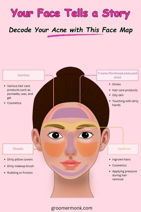 Acne Breakout Chart, Face Mapping Acne Break Outs, Acne Chart, Acne Face Map, Face Map, Acne Scar Removal Cream, Skin Breaking Out, Face Mapping Acne, Bad Acne