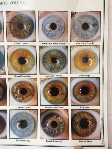 A - Iris Signs Chart #3 Iridology Chart Eye, Eye Color Chart Genetics, Dr Robert Morse, Iridology Chart, Eye Color Facts, Robert Morse, Rare Eye Colors, Iris Eye, Eye Color Chart