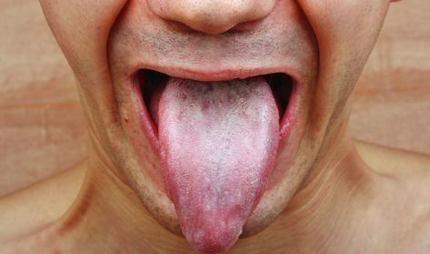 Do You Have Candida Overgrowth? White Tongue Causes, Candida Overgrowth Symptoms, Candida Symptoms, White Tongue, Saccharomyces Boulardii, Candida Overgrowth, Small Intestine Bacterial Overgrowth, Abdominal Discomfort, Candida Albicans