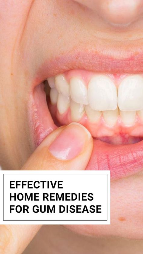 Tooth Decay Remedies, Stronger Teeth, Periodontal Disease, Oral Health Care, Tooth Decay, Oral Hygiene, Management Tips, Teeth Cleaning, Dental Health